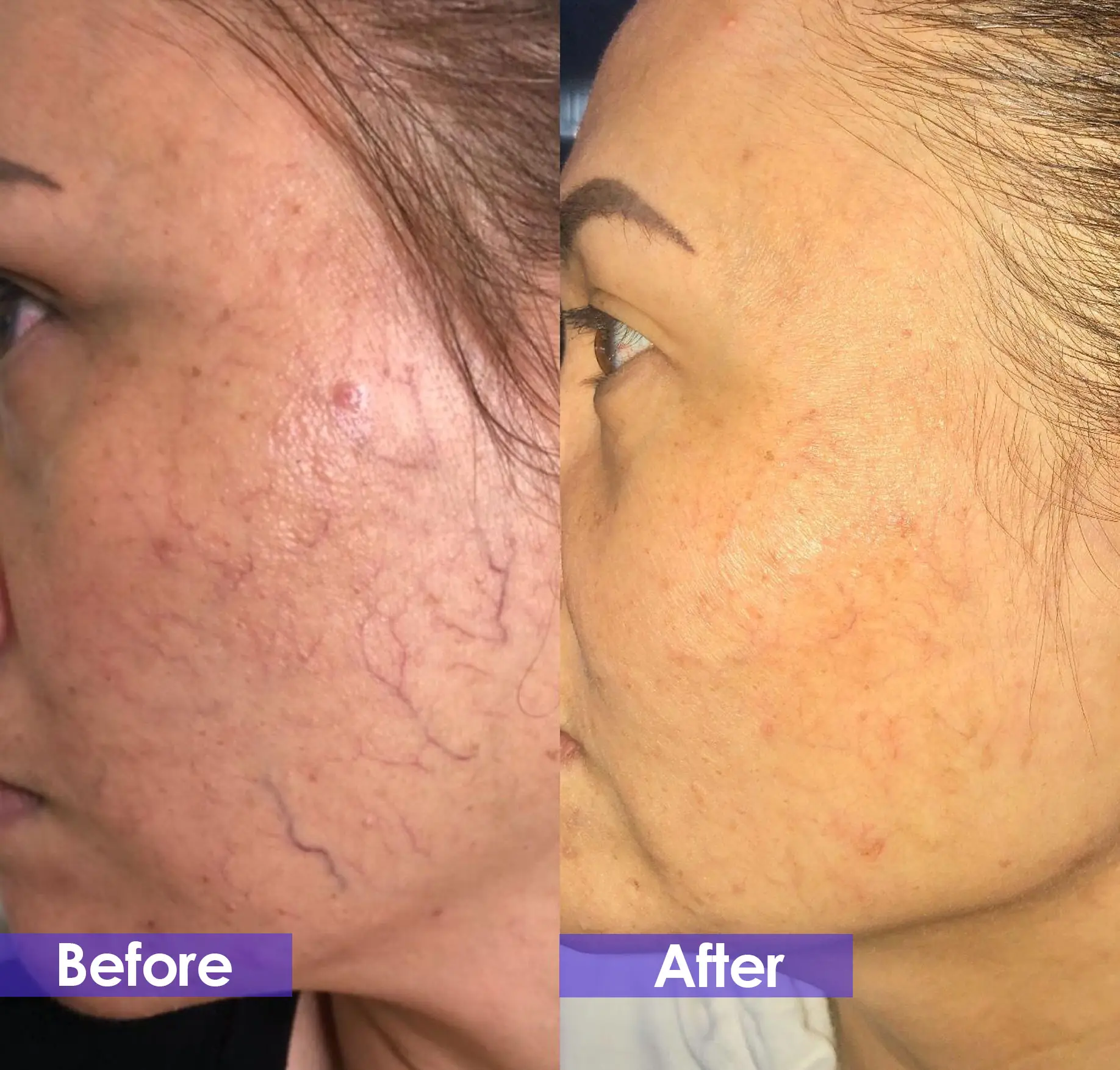 spider veins removal before and after